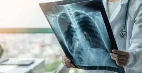 Turbekulozi/ Sëmundja infektive më vdekjeprurëse, ja shifrat e të prekurve në 2024-ën