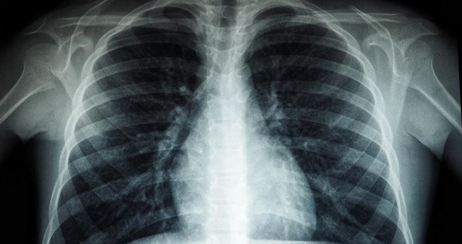 “Vret 1 milion njerëz çdo vit”/ OBSH, ngre alarmin: Tuberkulozi, është sëmundja infektive më vdekjeprurëse në botë