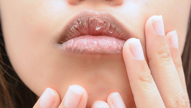 4 arsyet pse i keni buzët e plasaritura sidomos gjatë dimrit