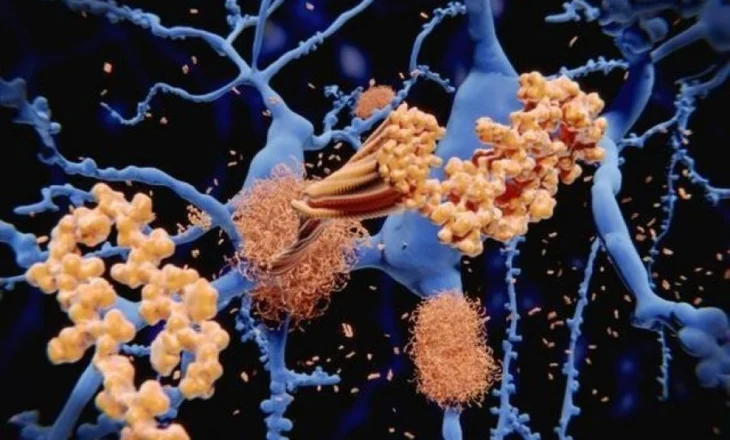 Identifikohet mekanizmi që bllokon proteinat toksike të Alzheimerit