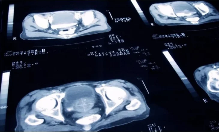 Inteligjenca artificiale hap rrugën për trajtim më të personalizuar të kancerit të prostatës