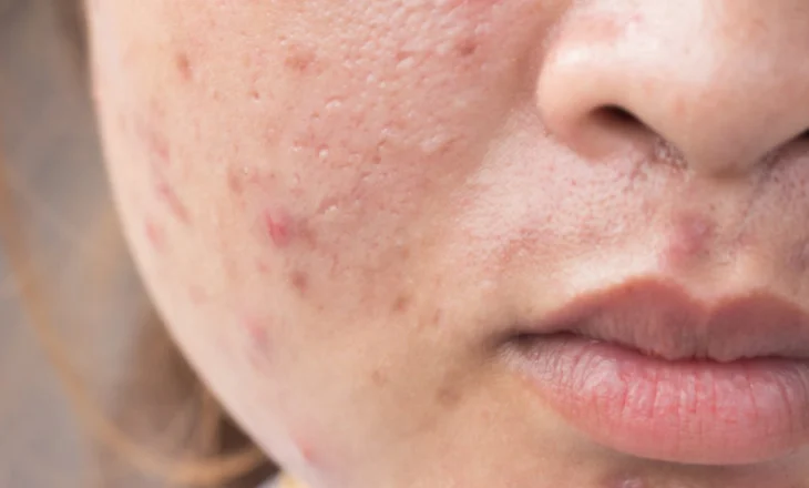 Shenjat e Çrregullimeve Hormonale që nuk Duhen Injoruar