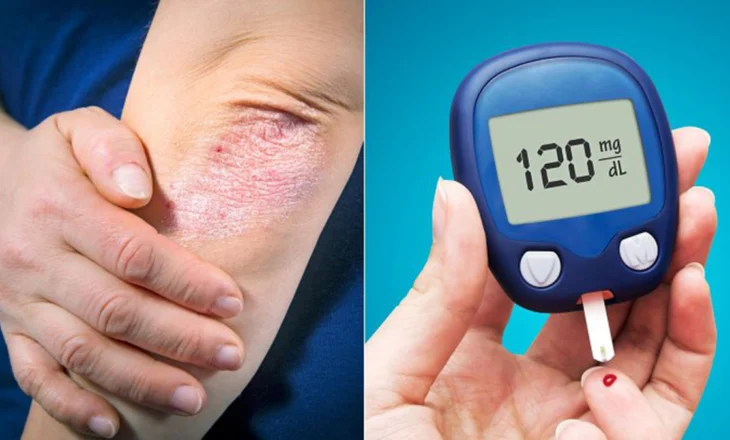 Si Ndryshojnë Simptomat e Diabetit tek Gratë dhe Burrat