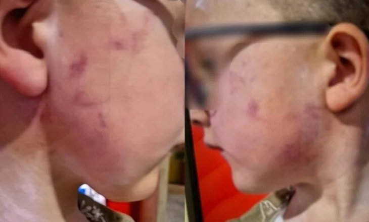 Djalin e mori nga kopshti me shenja të nxira në fytyrë! Pronarja e ‘Gledis’ denoncon nënën: Më prishi imazhin