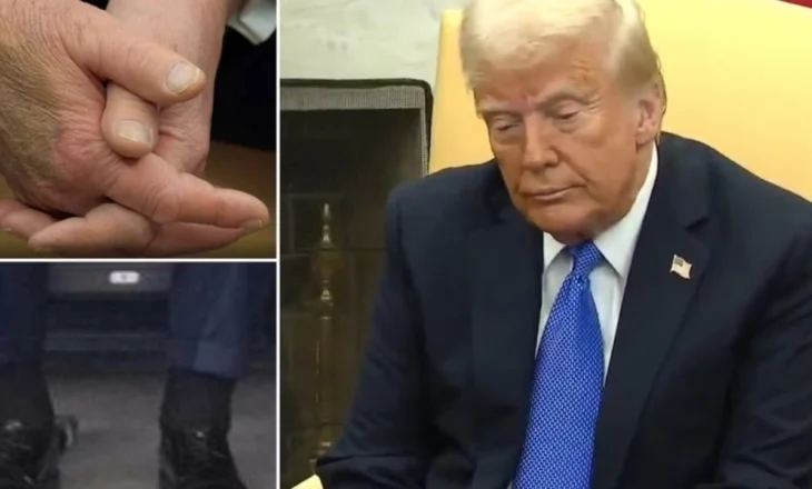 Me kyçet e këmbëve të fryra dhe duar të mavijosura, Shtëpia e Bardhë hedh dritë mbi shëndetin e Trump: Ai vuan nga…