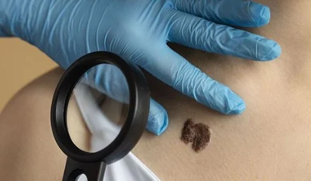 Nishanët rrezik nga dielli? Paralajmërojnë dermatologët, ja kush rrezikohet më shumë dhe si të mbroheni