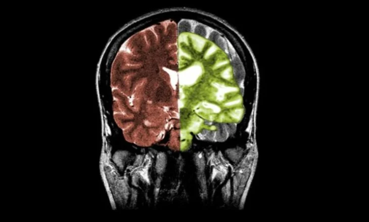 Një shpresë e re për trajtimin e Alzheimer dhe Parkinsonit