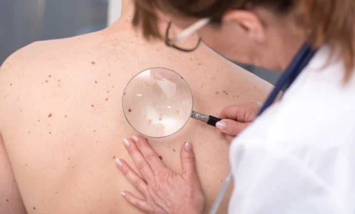 Njollat e diellit dhe tumoret e lëkurës: si t’i dallojmë dhe si bëhet diagnoza