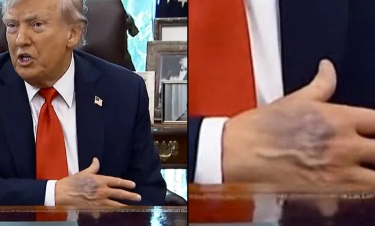 Foto/ Dora e nxirë e Donald Trump bën xhiron e rrjetit, Shtëpia e Bardhë sqaron gjendjen shëndetësore të Presidentit amerikan