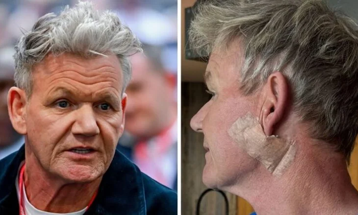 Gordon Ramsay kalon nëpër një operacion për kancerin e lëkurës: Mesazhi i tij për fansat