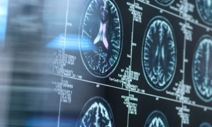 Një ilaç i vjetër, një shpresë e re: Litiumi mund të mbrojë trurin nga Alzheimeri!