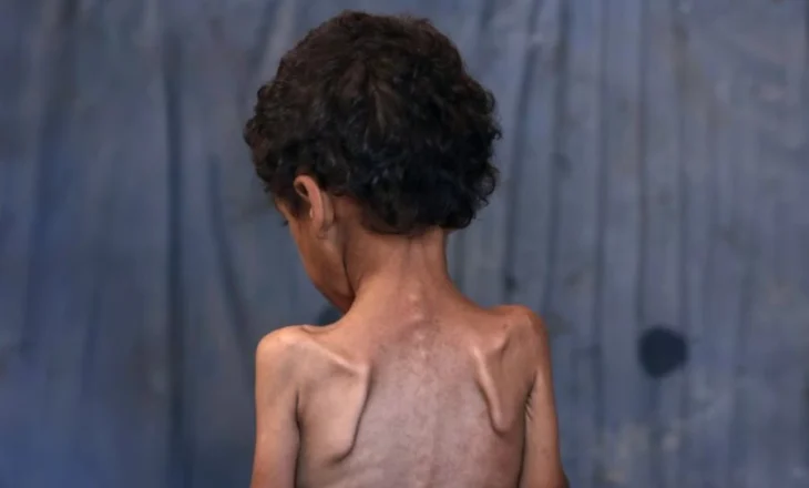 Trondit kreu i “Save the Children”: Fëmijët e uritur në Gaza nuk kanë fuqi as të qajnë!