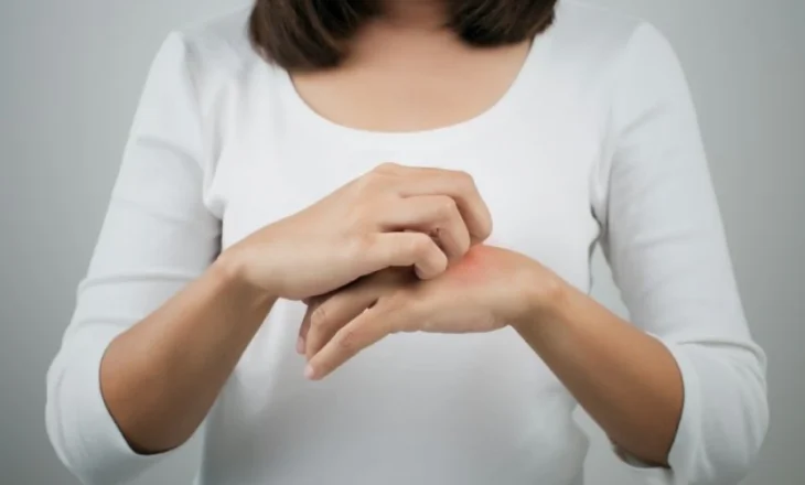 Dermatologia rendit disa zakone që mund ta përkeqësojnë ekzemën