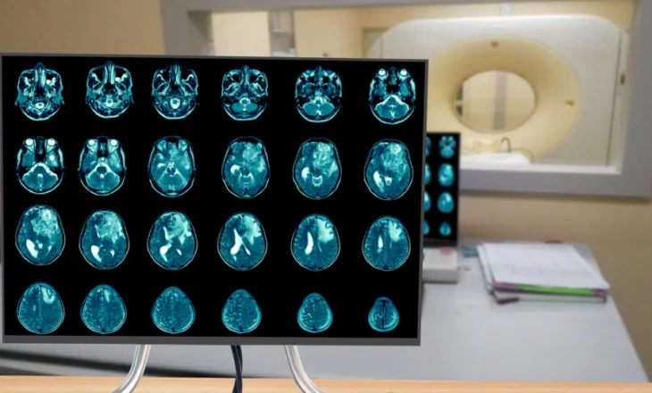 Glioblastoma, pozicioni i qelizave tumorale zbulon agresivitetin e tij