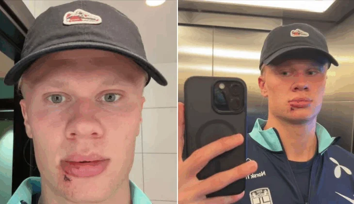 Tri qepje për Haaland, incidenti i pazakontë i yllit norvegjez në kombëtare