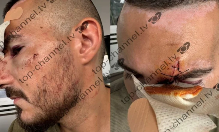 Turisti denoncoi në TCH sulmin dhe grabitjen nga pesë persona! Reagon Policia e Durrësit: Për rastin janë ndaluar dy minorenë