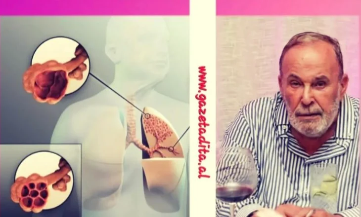 Nga se shkaktohet dhe çfarë është SPOK, sëmundja e pashërueshme që i mori jetën Fatos Nanos