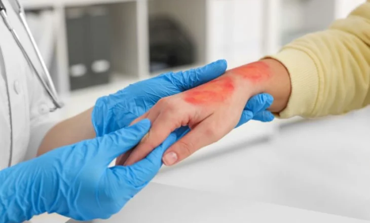 Djegiet/ Si të reagoni menjëherë?