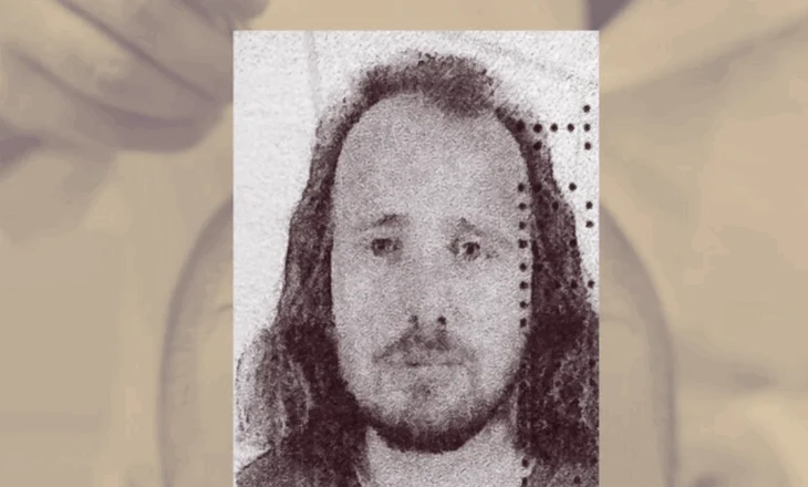 E rëndë në Turqi/ Shqiptari ndërron jetë pas transplantit të flokëve edhe një procedure dentare