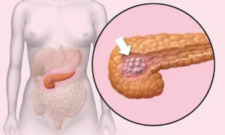 Kanceri i pankreasit, zakoni i rrezikshëm që ‘shkakton’ formën agresive të sëmundjes
