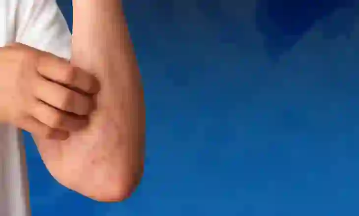 Kruarje, djersitje dhe lodhje – sëmundje e rrallë e gjakut që kërkon trajtim të hershëm dhe terapi inovative