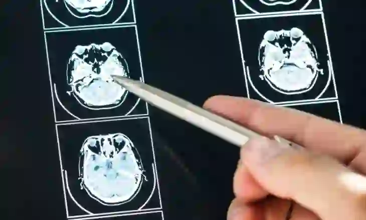 Një në tre shqiptarë vuan nga sëmundjet e sistemit nervor – kujdes shenjat!