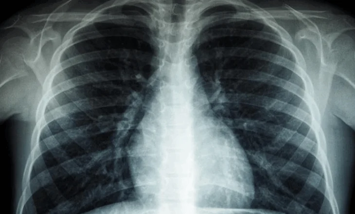 OBSH: Tuberkulozi është sëmundja infektive më vdekjeprurëse në botë, vret 1 milion njerëz çdo vit