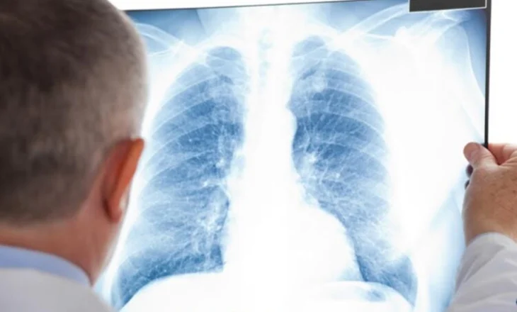 OBSH: Tuberkulozi, sëmundja më vdekjeprurëse infektive në botë për 2024-ën