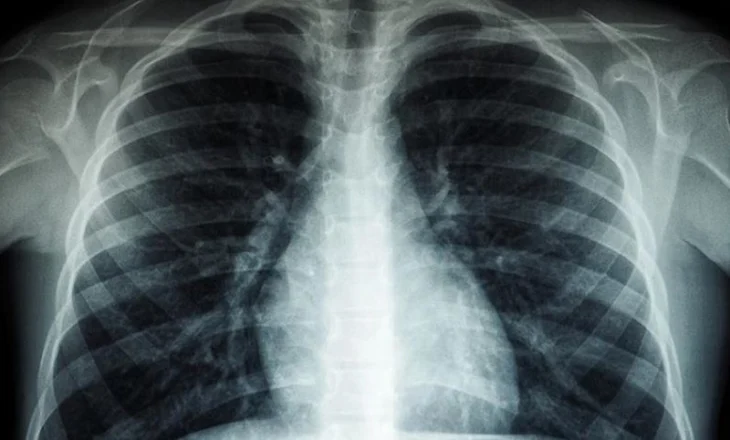 “Vret 1 milion njerëz çdo vit”/ OBSH, ngre alarmin: Tuberkulozi, është sëmundja infektive më vdekjeprurëse në botë