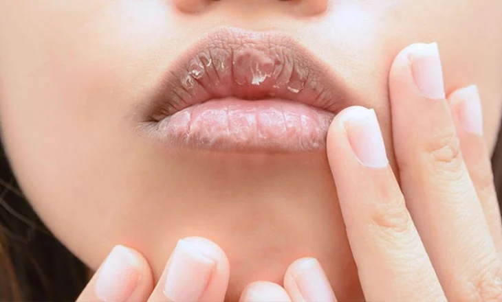 4 arsyet pse i keni buzët e plasaritura sidomos gjatë dimrit