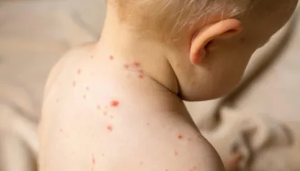 “Fruthi, sëmundje ngjitëse dhe jep pasoja goxha të rënda”/ Rastet në Shqipëri, epidemiologia: Mosvaksinimi jep rrezik