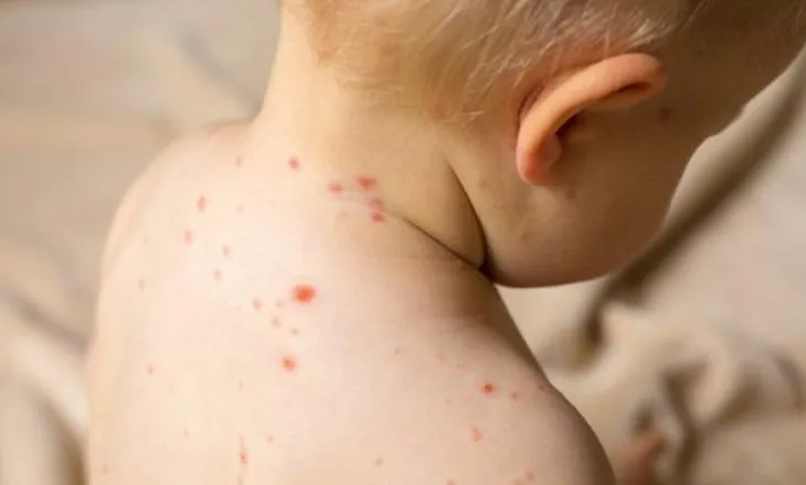 “Fruthi, sëmundje ngjitëse dhe jep pasoja goxha të rënda”/ Rastet në Shqipëri, epidemiologia: Mosvaksinimi jep rrezik