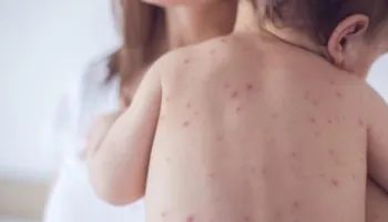 Konfirmohet rasti i parë i fruthit në Shqipëri, i infektuar një fëmijë