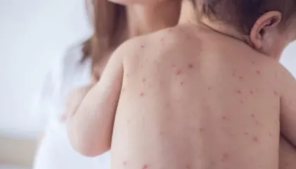 Konfirmohet rasti i parë i fruthit në Shqipëri, i infektuar një fëmijë