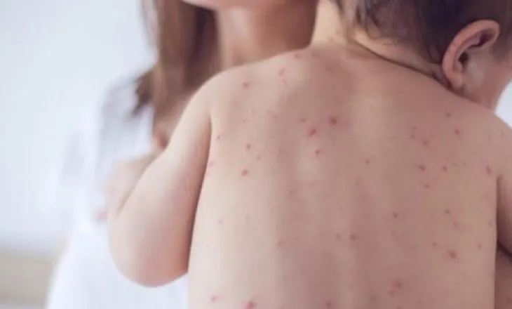 Konfirmohet rasti i parë i fruthit në Shqipëri, i infektuar një fëmijë