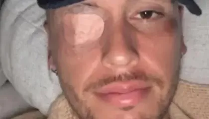 Lucas Ocampos pëson paralizë faciale, duhet të qëndrojë dy javë pushim absolut