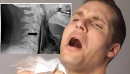 Mbajtja e teshtimës mund të jetë e rrezikshme, rasti i 34 vjeçarit që pësoi çarje fyti