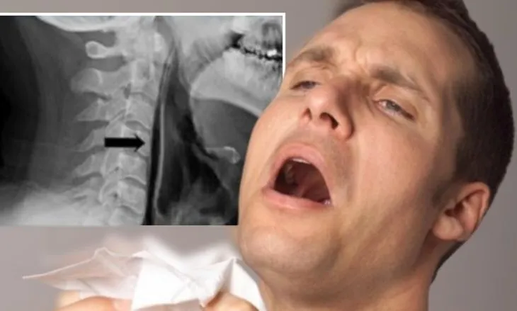 Mbajtja e teshtimës mund të jetë e rrezikshme, rasti i 34 vjeçarit që pësoi çarje fyti