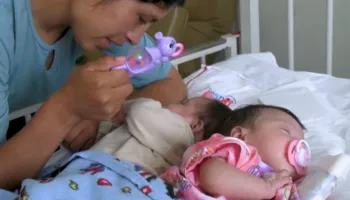 “Mrekulli e Krishtlindjeve”, binjaket siameze ndahen me sukses pas disa orësh operacion