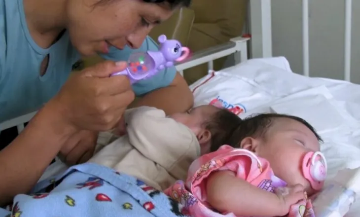 “Mrekulli e Krishtlindjeve”, binjaket siameze ndahen me sukses pas disa orësh operacion