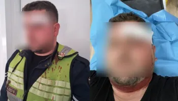 Ndërhynë për të shuar një sherr, por përfunduan të dhunuar, publikohen fotot e dy efektivëve të “Rrugores”