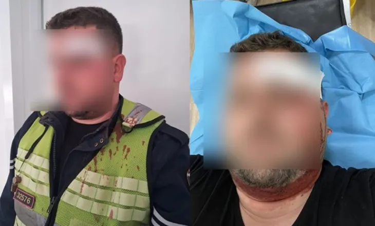 Ndërhynë për të shuar një sherr, por përfunduan të dhunuar, publikohen fotot e dy efektivëve të “Rrugores”