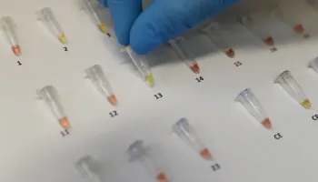 OBSH: Tuberkulozi, sëmundja më vdekjeprurëre në botë! Shifër rekord infektimesh