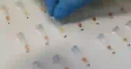 OBSH: Tuberkulozi, sëmundja më vdekjeprurëre në botë! Shifër rekord infektimesh