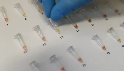 OBSH: Tuberkulozi, sëmundja më vdekjeprurëre në botë! Shifër rekord infektimesh