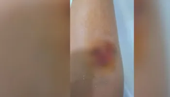 Qentë endacakë kafshojnë të miturin në Durrës, 8 vjeçari merr ndihmë mjekësore