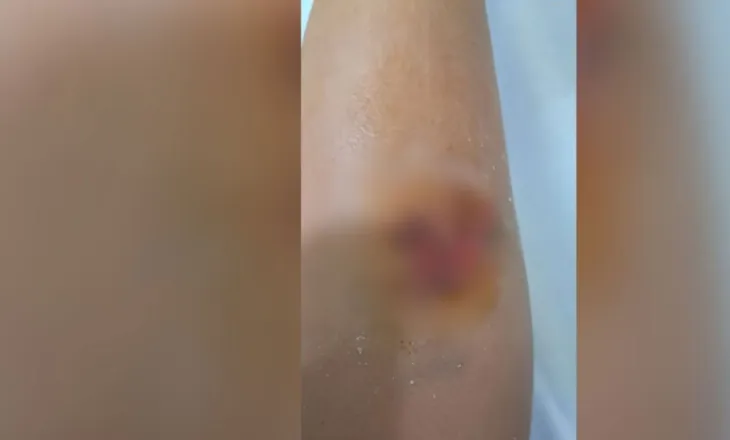 Qentë endacakë kafshojnë të miturin në Durrës, 8 vjeçari merr ndihmë mjekësore