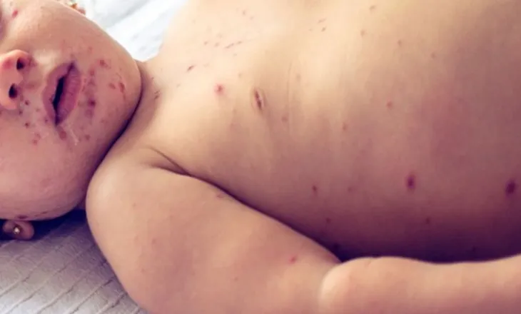 Tjetër rasti i fruthit në Shqipëri, fëmija i prekur është i pavaksinuar