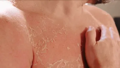 Vera shton rastet me infeksione në lëkurë