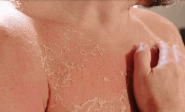 Vera shton rastet me infeksione në lëkurë